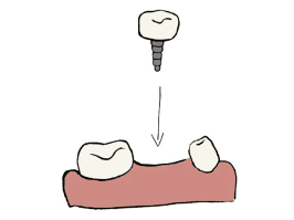 Zahn Implantat im Vergleich zur Brücke