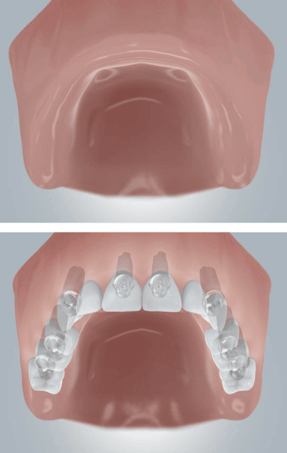 Zahnimplantate Zahnloser Oberkiefer