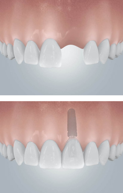 Zahnlücke Einzelzahnimplantant