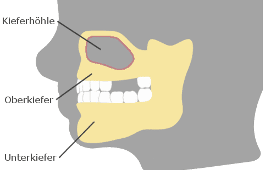 Knochenabbau im Oberkiefer