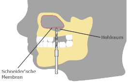 Knochenaufbau Schneidersche Membran