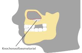 Knochenaufbaumaterial im Oberkiefer
