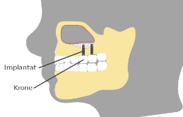 4. Implantat setzen Oberkiefer