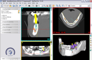 3d diagnostik knochenaufbau