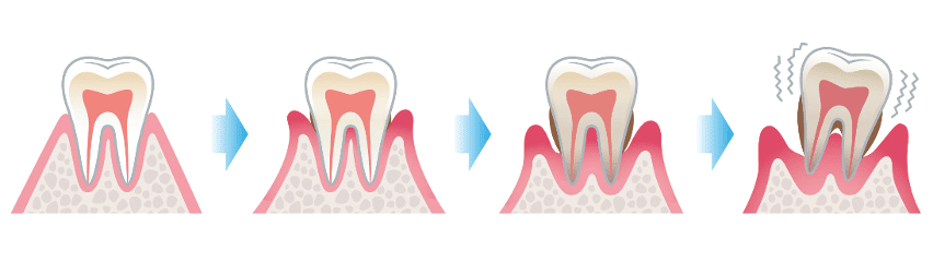 Entstehung einer Parodontitis: Knochenabbau, Zahnlockerung Zahnverlust