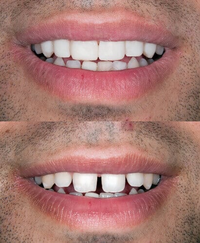 veneers zahnluecke schliessen