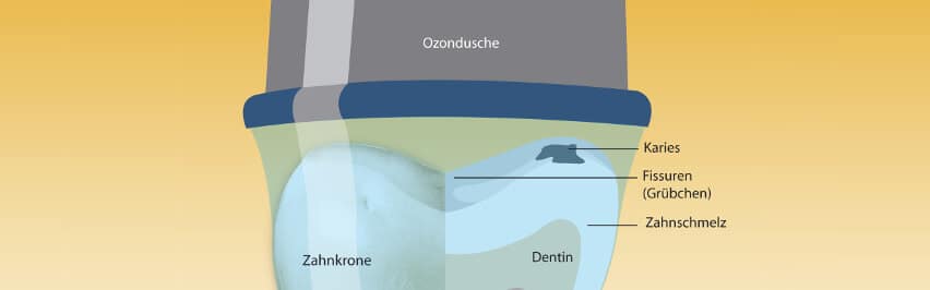 Ozondusche Karies behandeln