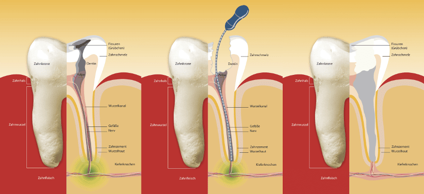wurzelbehandlung ablauf