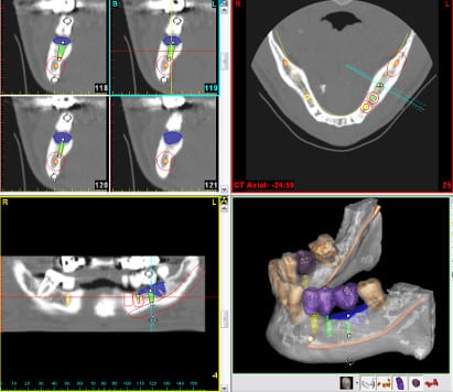 3d implantations planung dvt