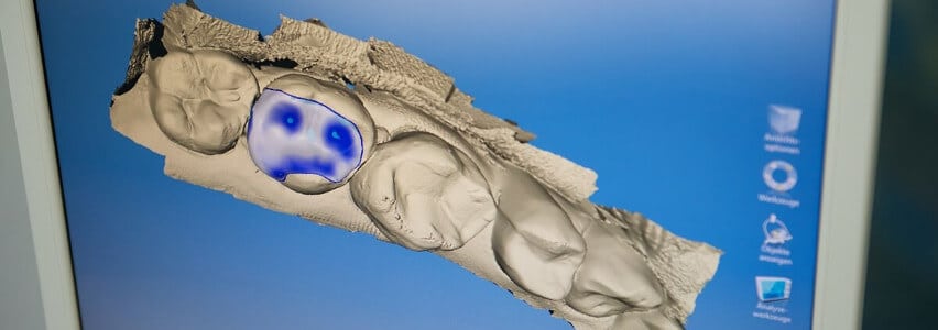 cad cam cerec ästhetischer zahnersatz