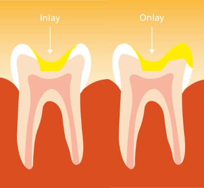 zahn füllung inlay & onlay