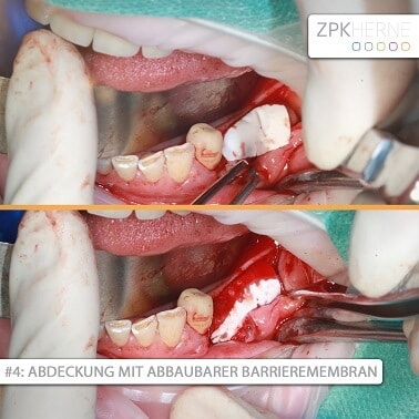 Knochenaufbau - Abdeckung mit Membran