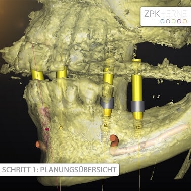 Knochenaufbau Planungsübersicht