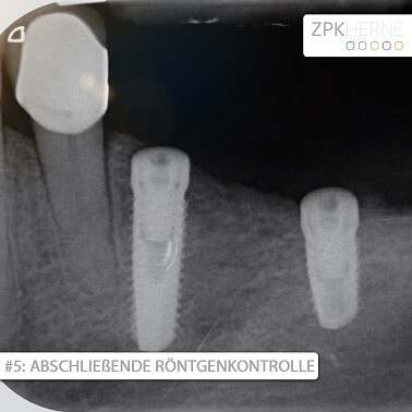 Röntgenkontrolle nach Knochenaufbau