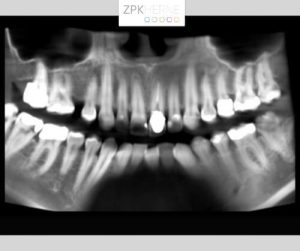 Radiologische Aufnahme mit entzündeter Wurzelspitze