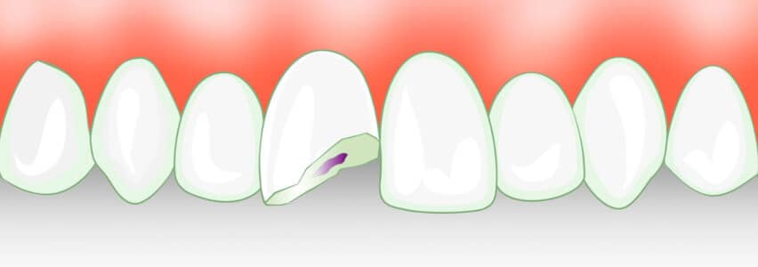 Zahntrauma Zahn Abgebrochen Was Ist Zu Tun
